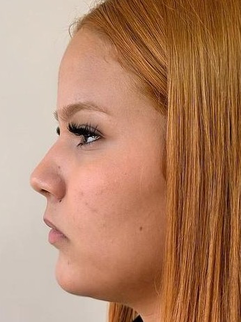 Antes do Protocolo Perfil Perfeito