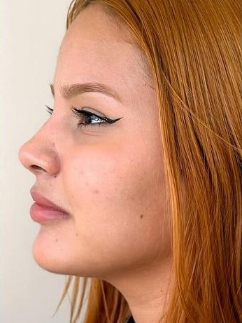 Depois do Protocolo Perfil Perfeito