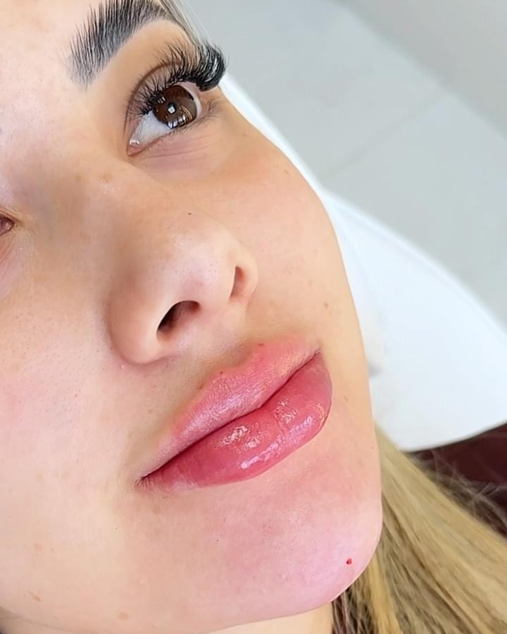 Preenchimento labial